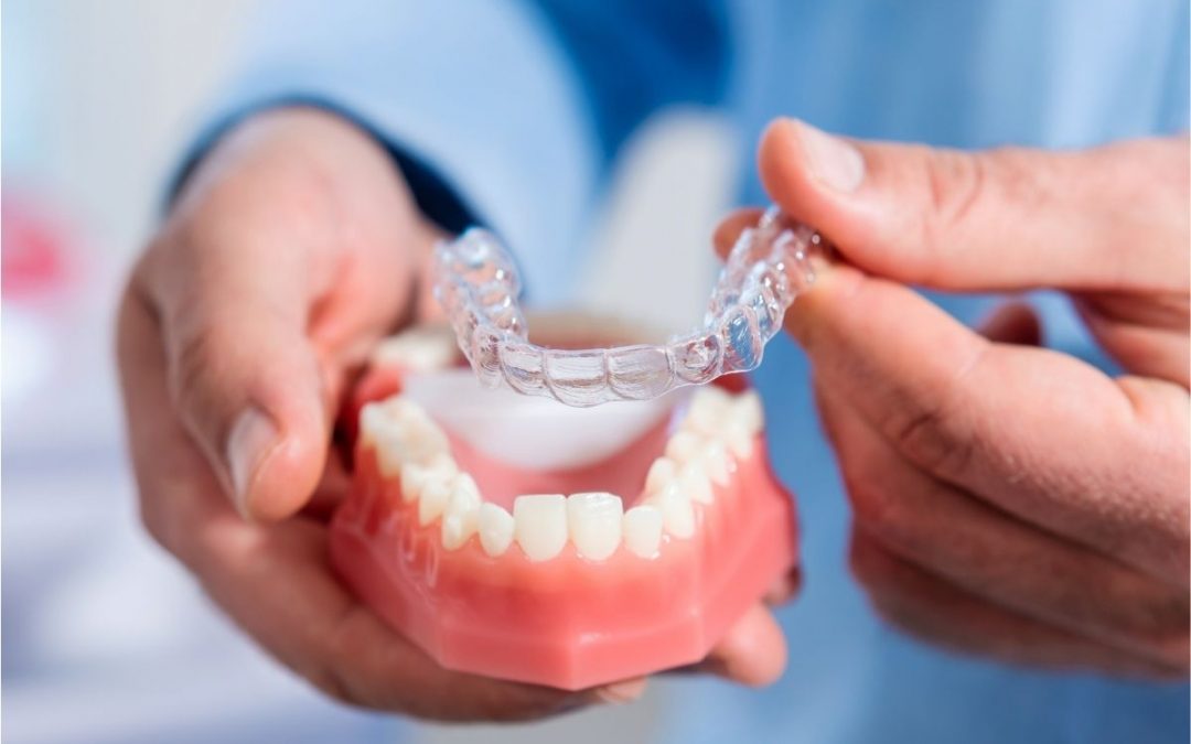 Allineatori dentali trasparenti, cosa sono e quali vantaggi offrono