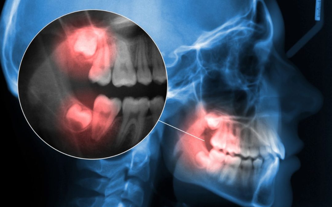 Pericoronite Dente del Giudizio