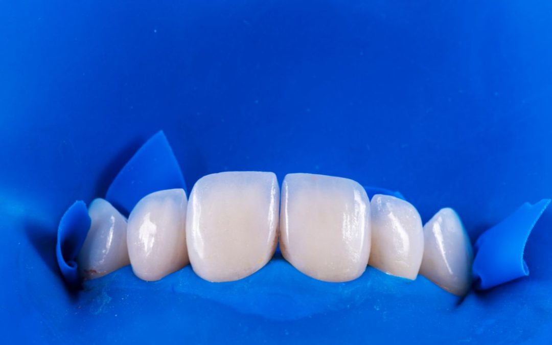 Faccette dentali, quali problemi possono correggere e come prendersene cura