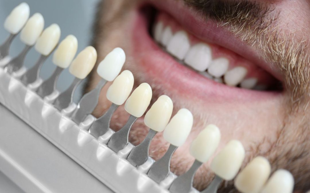 Faccette dentali: a Salerno una soluzione per l’estetica dei denti