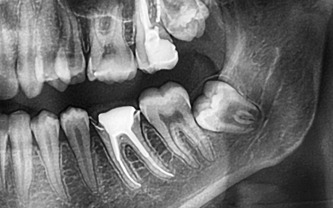 Denti del giudizio: problemi e soluzioni