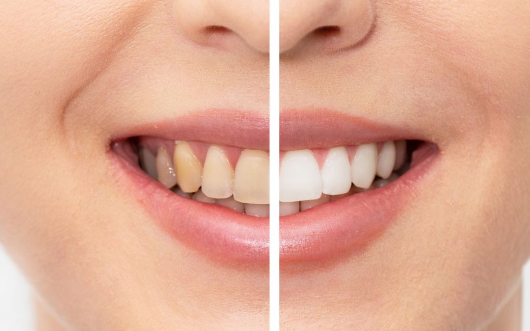 Denti gialli? Ecco i rimedi per un sorriso più splendente