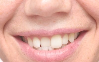 Denti storti negli adulti: come correggerli e migliorare l’autostima